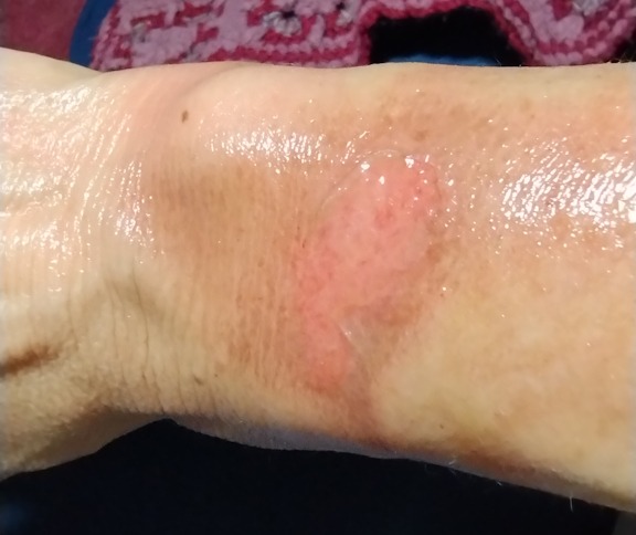 arm burn