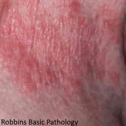eczema - Robbins Basic Pathology