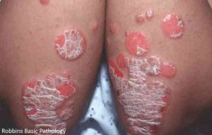 psoriasis - Robbins Basic Pathology